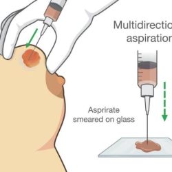 Joint ganglion cyst cpt gout drainage lidocaine