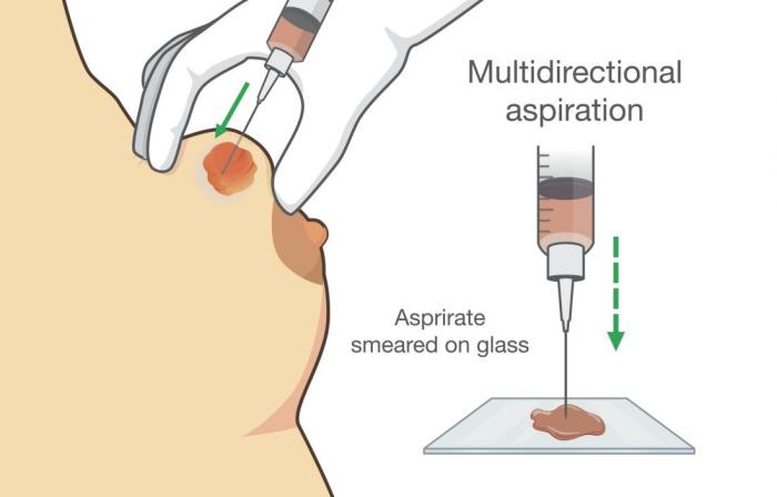 Joint ganglion cyst cpt gout drainage lidocaine