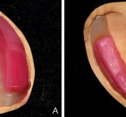 Occlusal