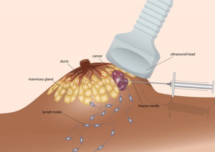 Needle aspiration biopsy cytology procedure indications nurseinfo